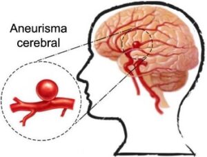 Imagem 4 - Exemplo de aneurisma cerebral